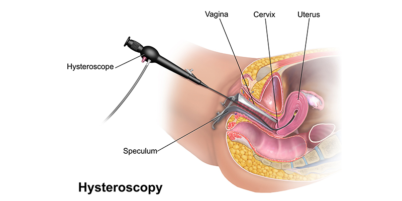 Hysteroscopy procedure illustration – a key fertility enhancing surgery used to diagnose and treat uterine abnormalities in women.